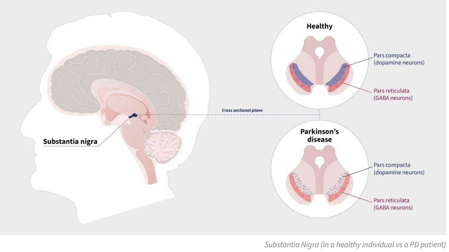 CUV Parkinsons